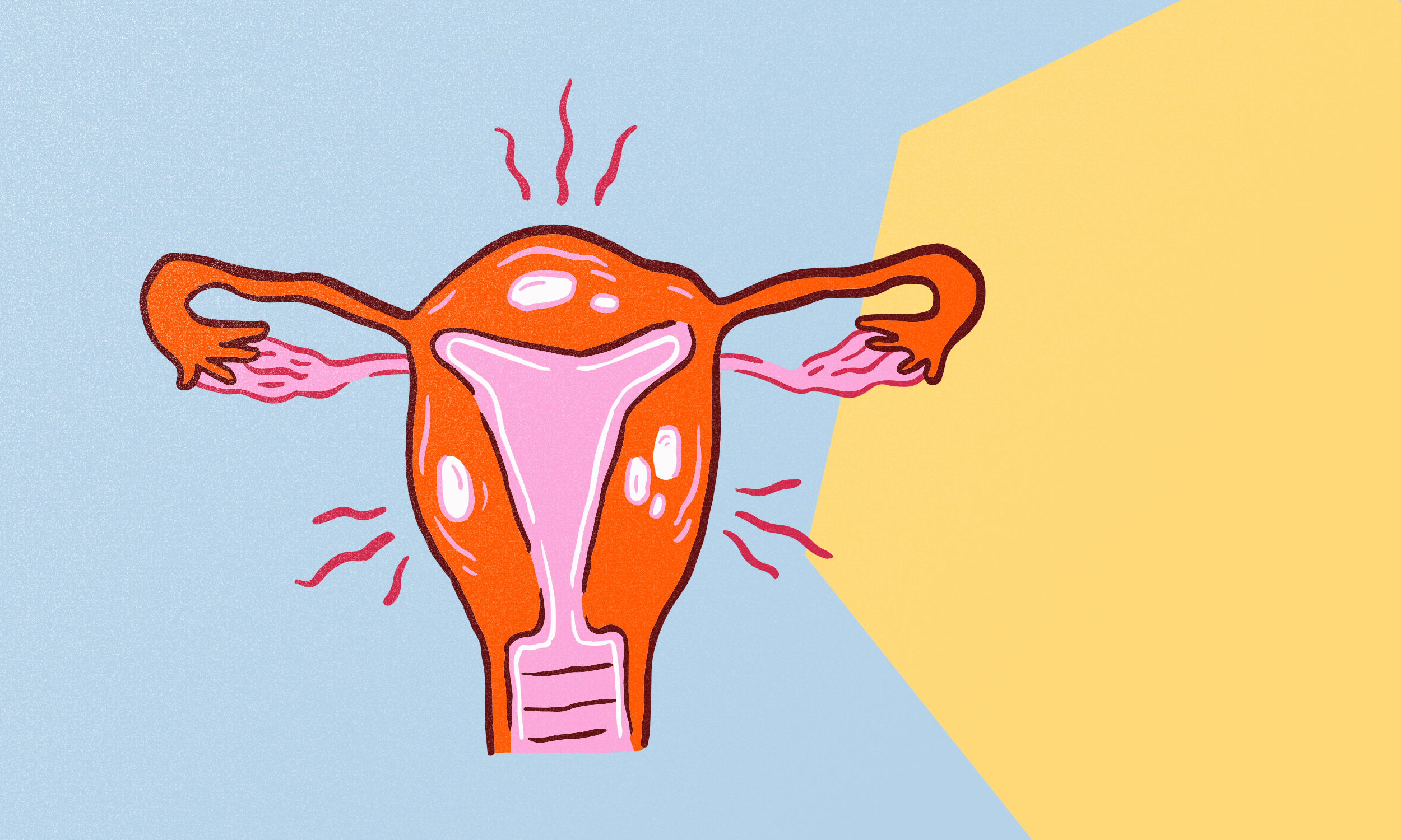 Hvad er endometriose? Symptomer, smerter og hvorfor sygdommen stadig overses